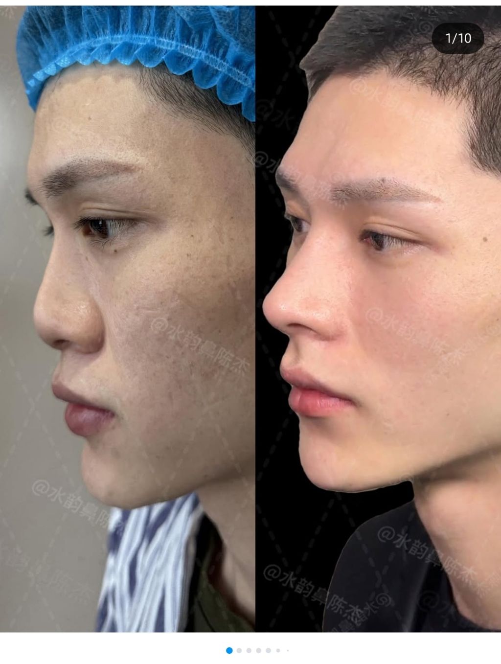 Ca Sửa Mũi Huyền Thoại Của Nam Giới Gây Chấn Động 2 558503647 792013086902336 928178558788676430 n